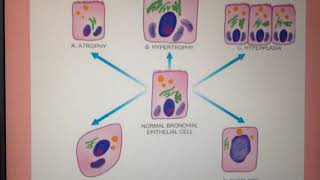 Cell Adaptations to stressHypertrophyHyperplasiaMetaplasia Atrophy [upl. by Anaher]