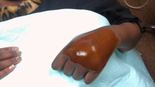 hand hematoma drainage [upl. by Otsuaf111]