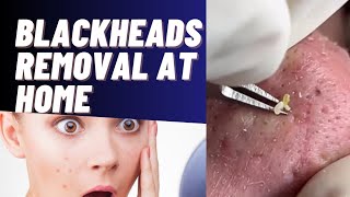 blackhead removal home remedies mask black heads extraction nikalny ka tarika [upl. by Leahciam924]