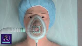 Inguinal Hernia Repair  Medical Animation Surgery [upl. by Treat]