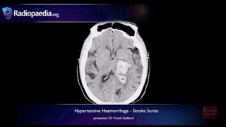 Stroke Hypertensive haemorrhage  radiology video tutorial MRI CT [upl. by Fugere776]