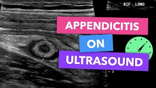 Appendicitis on ultrasound  Radiopaedias Emergency Radiology Course [upl. by Gorga]