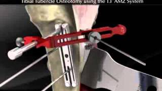 Tibial Tubercle Osteotomy using the T3 AMZ System [upl. by Thormora]