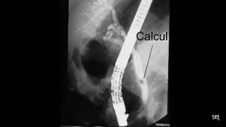 Cholangiopancréatographie rétrograde endoscopique [upl. by Iloj]