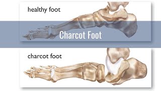 Charcot Foot  What YOU need to KNOW [upl. by Venola]