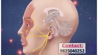 Trigeminal neuralgia treatment radio frequency ablation in ahmedabad gujrat [upl. by Goldin]