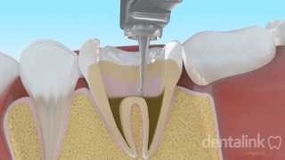 Endodoncia completa PASO A PASO  Video 3D [upl. by Anaira560]