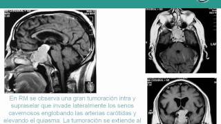 NeurorgsnetMacroadenoma de Hipófisis [upl. by Bullock610]