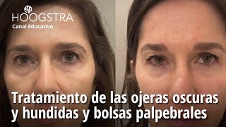 Tratamiento de las ojeras oscuras y hundidas y bolsas palpebrales  23239 [upl. by Nelg602]