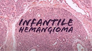 Infantile hemangioma quotStrawberry birthmarkquot under the microscope pathology dermpath dermatology [upl. by Grosberg]