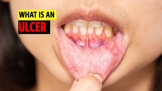 What is an Ulcer [upl. by Colleen]