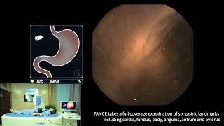 OMOM Robotic Capsule Endoscopy System Procedure [upl. by Neelhtak96]