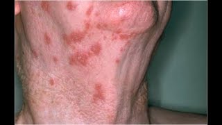 How Contagious Is Shingles Shingles Without Rash Early Signs Of Shingles Signs Of Shingles [upl. by Gardy938]