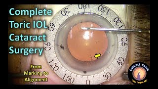 Toric IOL Cataract Surgery Complete from Marking to Alignment [upl. by Fuld]