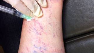 Spider Vein Sclerotherapy Treatment by Dr Mimi Lee [upl. by Asilad]