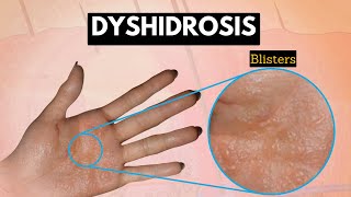 Dyshidrosis Causes Signs and Symptoms Diagnosis and Treatment [upl. by Gawlas]