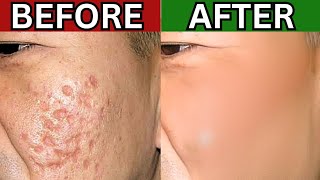 If Youre Above 40 But Want To Rid ACNE SCARS This Video Was Literally Made For You [upl. by Durr442]