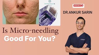 Facts about micro needling  Acne Scar Treatment  Dermapen 4  Morpheus 8 Dermaroller Dr Ankur [upl. by Crista490]