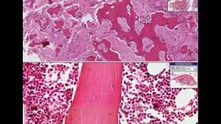 Histopathology BonePaget disease [upl. by Keyser358]