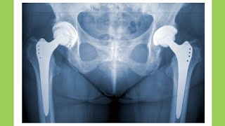 What is Hip Arthroplasty  shorts [upl. by Jankey]