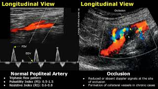 Popliteal Artery SpectralColor Doppler Ultrasound Normal Vs Abnormal Images  Vascular USG [upl. by Hsetirp425]