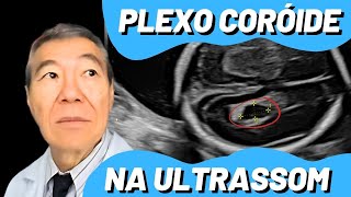 AO VIVO CISTO DE PLEXO CORÓIDE [upl. by Asilet]