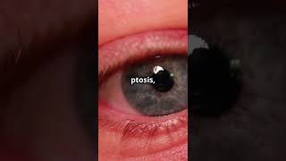 HornersSyndrome Neurology medicaleducation medicalstudent  DiagnosticLens [upl. by Egduj]