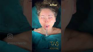 Scarless facelift and necklift blepharoplasty by DrTAS plasticsurgeon tasmedicalcenter [upl. by Erbas]