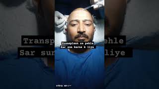 Hair transplant process hairtransplant [upl. by Estella]