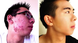 HOW TO COVER UP ACNE  FULL COVERAGE ROUTINE  MENS MAKEUP [upl. by Rooney]