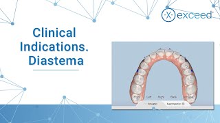 Clinical Indications Diastema [upl. by Victoria]