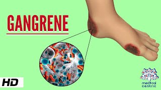 Gangrene Causes Signs and Symptoms Diagnosis and Treatment [upl. by Omari]