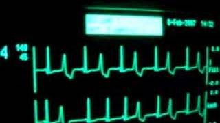 intensive care ecg with extrasystoles [upl. by Aihsekan8]