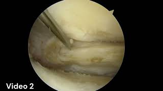 Indications and Technique Meniscus Root Repair [upl. by Orozco392]