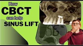 CBCT In Action Sinus Lift  Radiological evaluation of maxillary sinus anatomy before dental implant [upl. by Aksel]