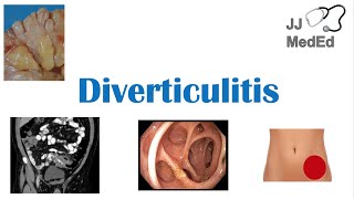 Diverticulitis Risk Factors ex Low Fiber Diets Symptoms Diagnosis Treatment and Complications [upl. by Emera]