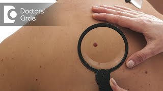 Difference between Melanoma and other skin pigmentations  Dr Rajdeep Mysore [upl. by Zennie]