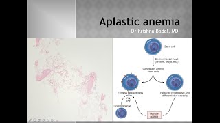 Aplastic anemia [upl. by Anisor512]