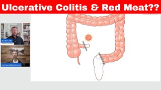 Ulcerative Colitis amp Red Meat Warning KENTCARNIVORE [upl. by Anuat]