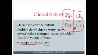 8 6 Cardiomyopathy 8 7 Cardiac Tumors [upl. by Atina485]