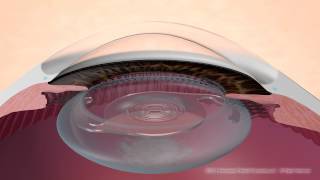 Secondary Cataract Treatment [upl. by Annayat]