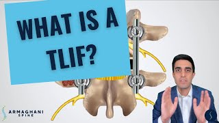 How I perform a TLIF and what to expect after [upl. by Nnyltiak]