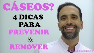 4 DICAS para PREVENIR e REMOVER CÁSEOS [upl. by Euh]