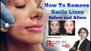 Smile Line Filler and PreventionBefore and After [upl. by Eberto]