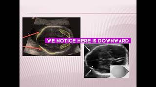 Ultrasonographic diagnosis of fetal spina bivida [upl. by Annim]