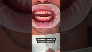 Porcelain veneers procedure  porcelain veneers before and after  cosmetic dentist  Dr Yazdan [upl. by Ah556]