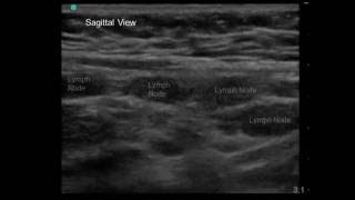 Mesenteric Adenitis in 7 yo Boy with Periumbilical Abdominal Pain and Vomiting [upl. by Alphonse]