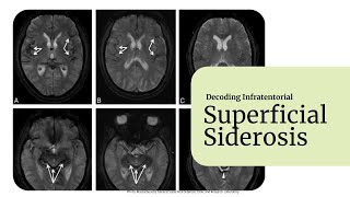 Decoding Superficial Siderosis [upl. by Ecyak926]