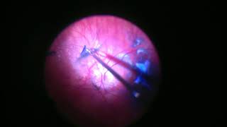 Difficult Posterior Hyaloid [upl. by Jeffers]