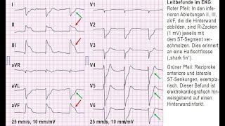 12 Kanal EKG Haifischflossenzeichen [upl. by Furlong]